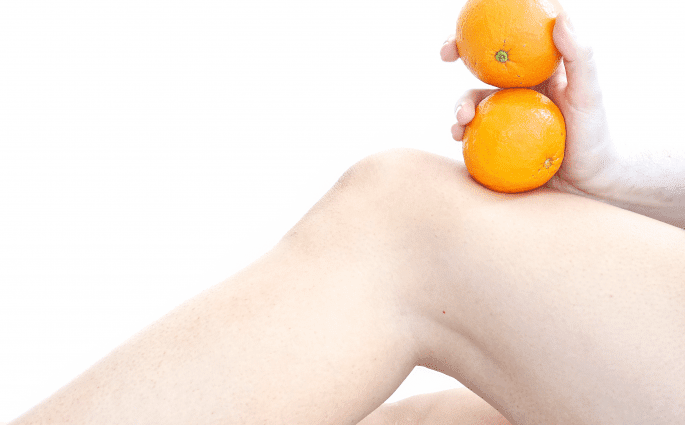 cellulite