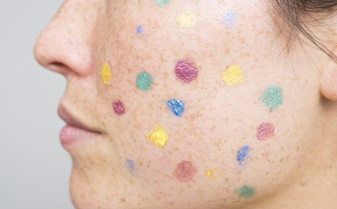reduce acne scars